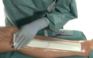 Instructievideo Mepilex Border Post-Op