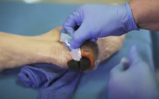 Instructievideo V.A.C. Therapy System verband op een voetwond